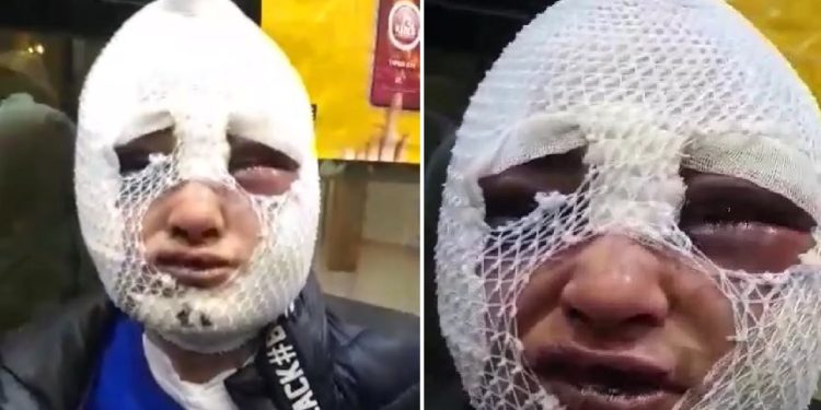 Eski sözlüsünün başından aşağı kızgın yağ döken sanığa tahliye